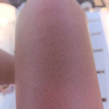 Benri Bronzlaştırıcı Yağ Ve Güneş Kremi Cildimi Korumadı, Ciddi Yanık Yaşadım