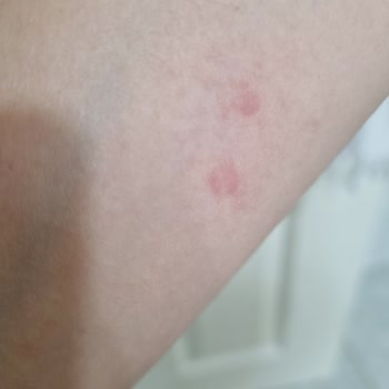 Saç Boyası Kullanımı Sonrası Ciddi Alerjik Reaksiyon Ve Sağlık Sorunları