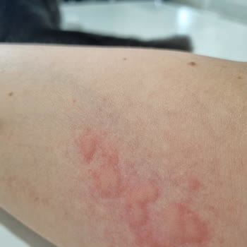 Saç Boyası Kullanımı Sonrası Ciddi Alerjik Reaksiyon Ve Sağlık Sorunları