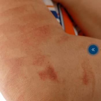 Paristanbul Beauty Lazerde İki Kolumda Yandı