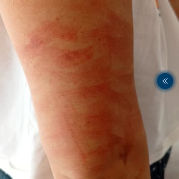 Paristanbul Beauty Lazerde İki Kolumda Yandı