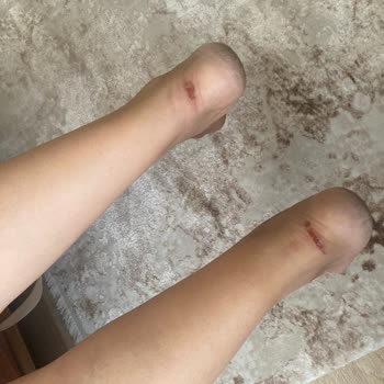 Aldığımız Babet Annemin Ayağını Yaraladı, Mağaza Çözüm Sunmadı