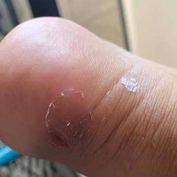 Aldığım Puma Ayakkabı Ayağımı Yaraladı, Mağaza Çözüm Sunmuyor