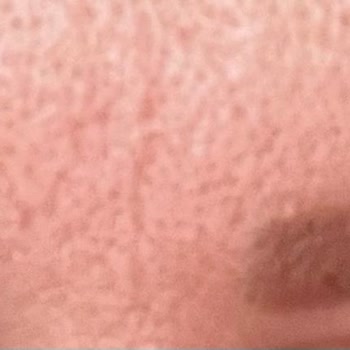 Kaş Uygulamasında Simetri Hataları Ve Yanıltıcı İşlem Bilgilendirmesi