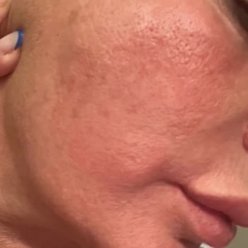 Serum Yüzümde Şiddetli Alerji Ve Şişlik Yaptı