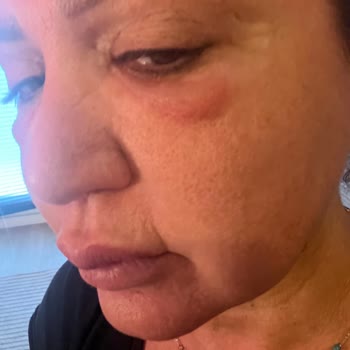 Serum Yüzümde Şiddetli Alerji Ve Şişlik Yaptı