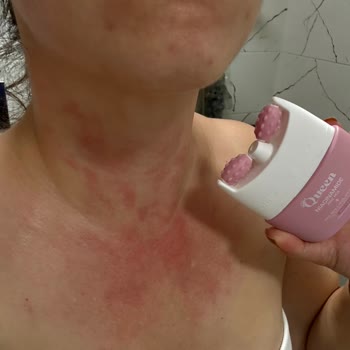 Krem Kullanımı Sonrası Ciltte Yanma Ve Kızarıklık Şikayeti