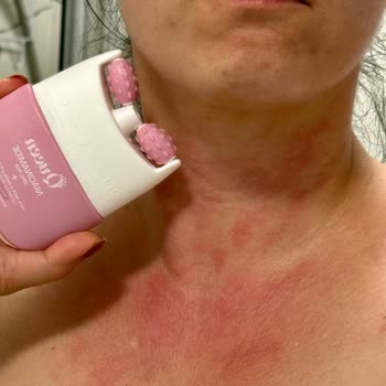 Krem Kullanımı Sonrası Ciltte Yanma Ve Kızarıklık Şikayeti