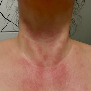 Krem Kullanımı Sonrası Ciltte Yanma Ve Kızarıklık Şikayeti