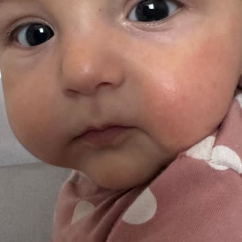 Bebeğimde Mustela Krem Kullanımı Sonrası Ciltte Kızarıklık Ve Tahriş