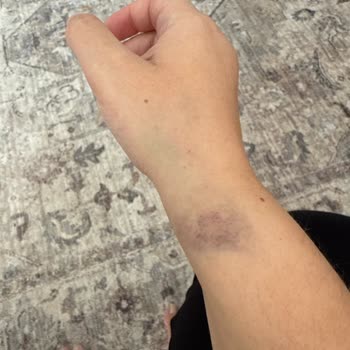 Deneyimsiz Hemşire Uygulaması Sonrası Kolumda Ciddi Morarma Oluştu