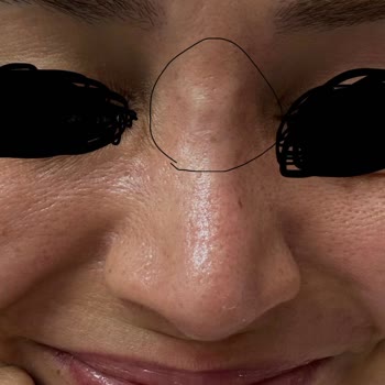 Burun Estetiği Sonrası Kalıcı Sağlık Sorunları Ve İlgisiz Doktor