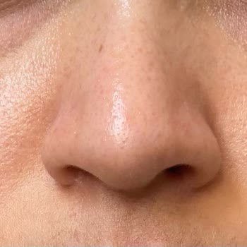 Burun Estetiği Sonrası Kalıcı Sağlık Sorunları Ve İlgisiz Doktor