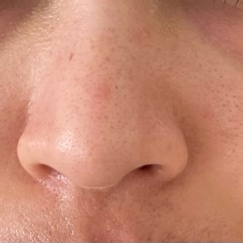 Burun Estetiği Sonrası Kalıcı Sağlık Sorunları Ve İlgisiz Doktor