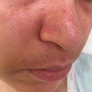 Burun Estetiği Sonrası Kalıcı Sağlık Sorunları Ve İlgisiz Doktor