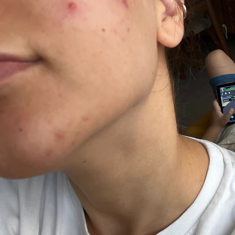 Otacı Güllü Su Ve Tonik Cildimde Alerjik Reaksiyonlara Sebep Oldu