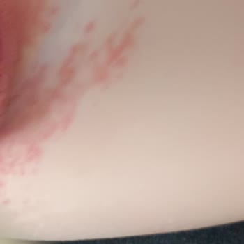 Molfix Islak Mendil Kullanımı Sonrası Oğlumda Pişik Ve Mantar Problemi