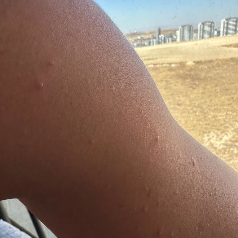 Johnson’s Baby Yağı Cildimde Sivilce Sorunu Yarattı