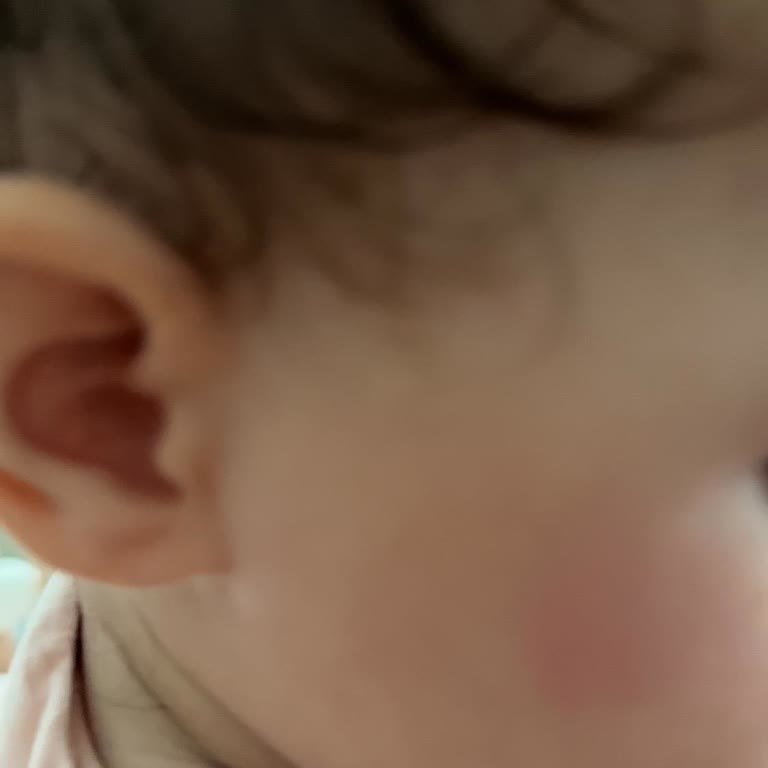 Bebek Cildinde Mustela Arnica Jel Sonrası Beklenmeyen Kızarıklık