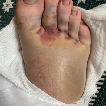 Martı Mobilet Kullanımı Sırasında Yaşanan Ciddi Kaza Ve Mağduriyet