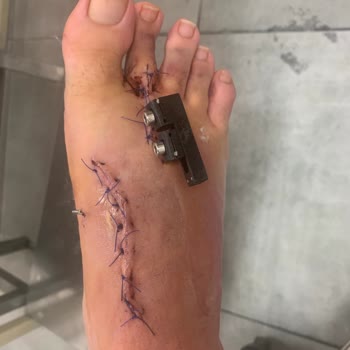 Martı Mobilet Kullanımı Sırasında Yaşanan Ciddi Kaza Ve Mağduriyet