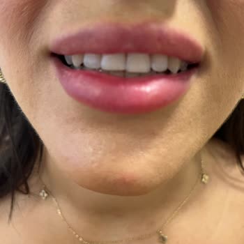 Dudak Dolgusu Sonrası Asimetri Ve Güvensizlik: Fatura Ve Garanti Belgesi Verilmedi