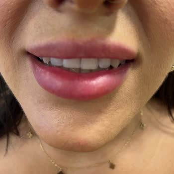 Dudak Dolgusu Sonrası Asimetri Ve Güvensizlik: Fatura Ve Garanti Belgesi Verilmedi