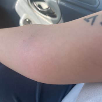 Acil Serviste Yanlış Serum Uygulaması Ve Dikkatsiz Sağlık Personeli Mağduriyeti