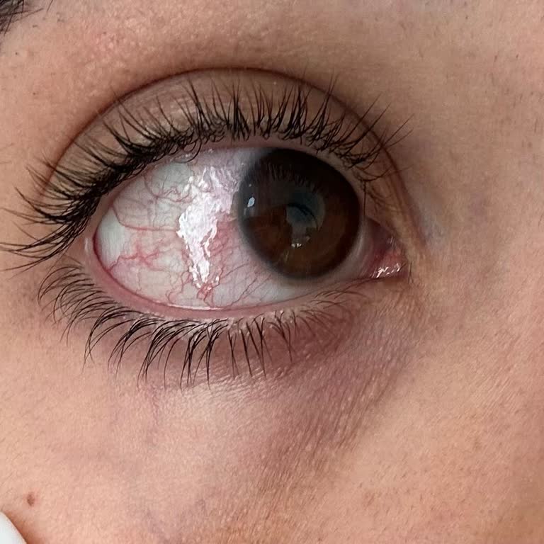 Lensler Göz Sağlığımı Ciddi Şekilde Tehdit Etti, Çözüm Alamadım