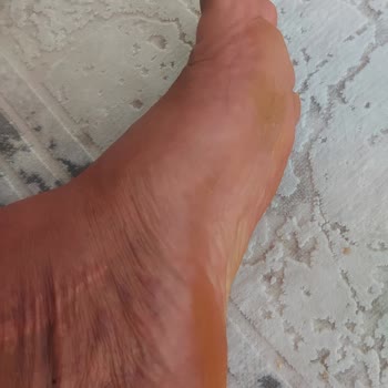 Kısa Sürede Deforme Olan Terliğe Çözüm Sunulmadı