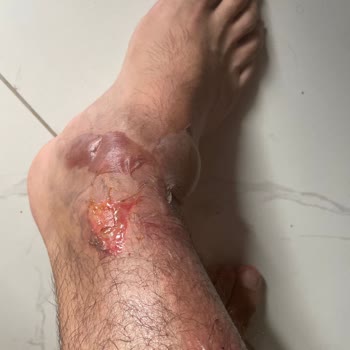 Karaca Termos Patladı Ciddi Yanık Ve Mağduriyet Yaşadım Çözüm Sunulmadı