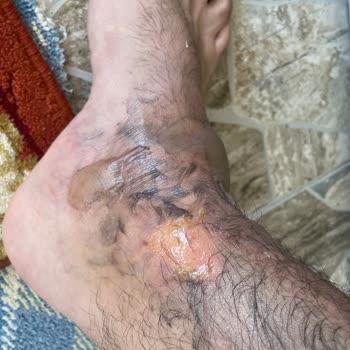 Karaca Termos Patladı Ciddi Yanık Ve Mağduriyet Yaşadım Çözüm Sunulmadı