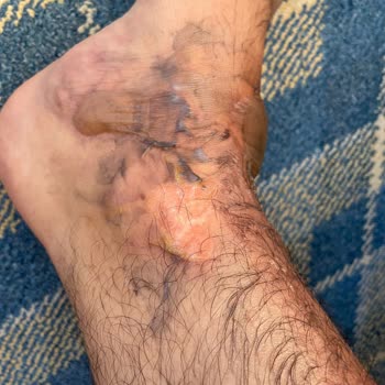 Karaca Termos Patladı Ciddi Yanık Ve Mağduriyet Yaşadım Çözüm Sunulmadı