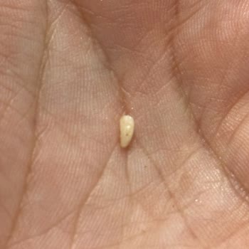 Dondurulmuş Dana Dönerden Kemik Parçası Çıktı