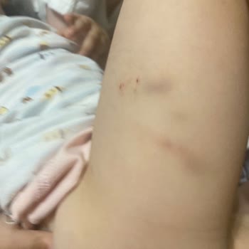 Anaokulunda Güvenlik Ve İlgisizlik Nedeniyle Çocuğumun Sağlığı Tehlikede