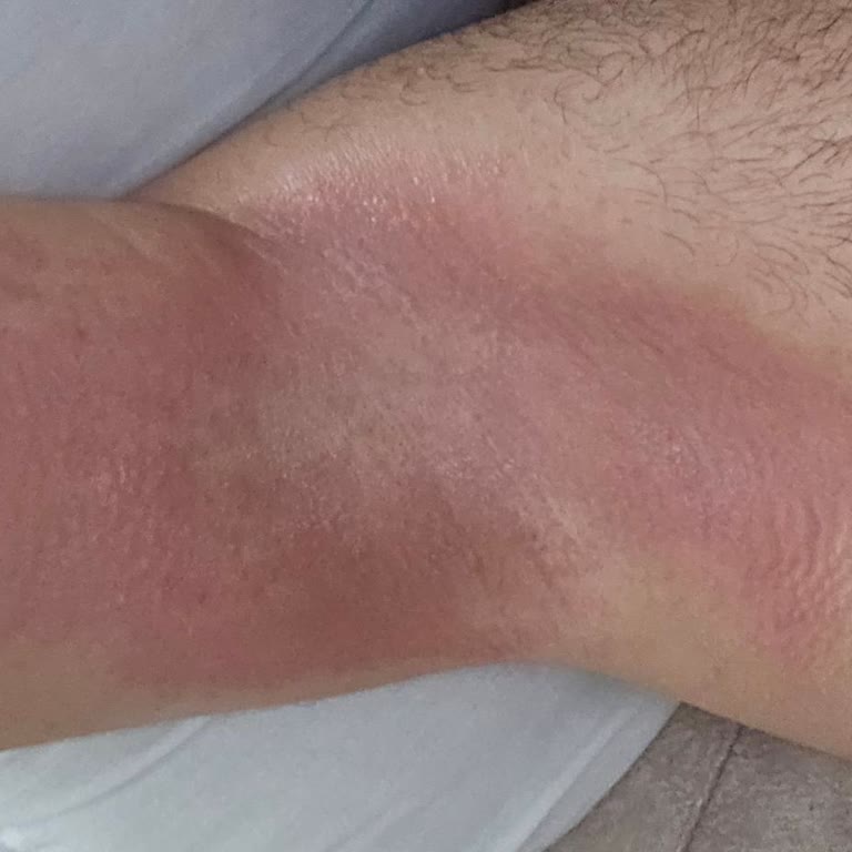 Koltuk Altımda Tereson Sprey Sonrası Yanık Ve Geçmeyen Acı