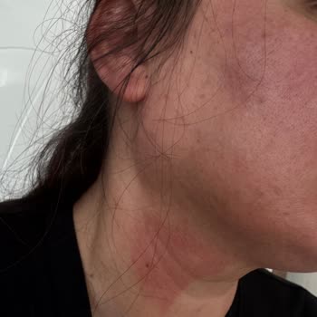 Hassas Ciltlere Uygun Denilen Güneş Kremi Ciltte Yanma Ve Kızarıklık Yaptı