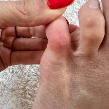 Kısa Süreli Kullanımda Ayakta Hasar Oluşturan Terlik İçin İade Talebi