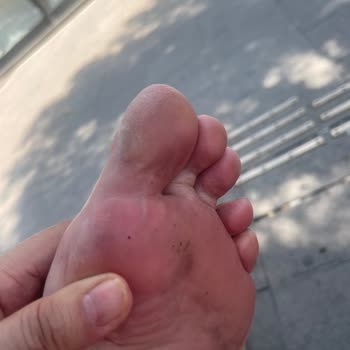 Yeni Aldığım Sandalet Ayağımı Yaraladı Mağaza Çözüm Sunmadı