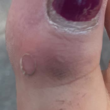 Yeni Aldığım Sandalet Ayağımı Yaraladı Mağaza Çözüm Sunmadı