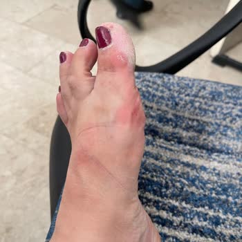 Yeni Aldığım Sandalet Ayağımı Yaraladı Mağaza Çözüm Sunmadı