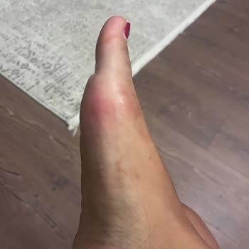 Kısa Sürede Hasar Veren Sandalet İçin İade Talebim Reddedildi