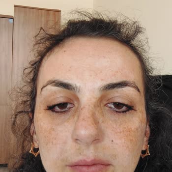 Babyface 3D Lazer Sonrası Yüzümde Kalıcı Hasar Ve İlgisiz Klinik Mağduriyeti