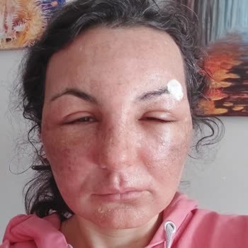 Babyface 3D Lazer Sonrası Yüzümde Kalıcı Hasar Ve İlgisiz Klinik Mağduriyeti