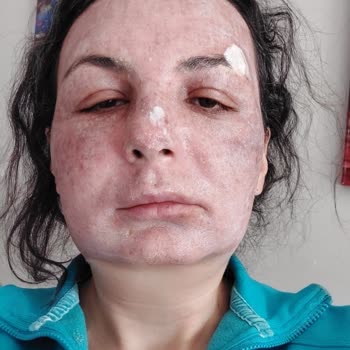 Babyface 3D Lazer Sonrası Yüzümde Kalıcı Hasar Ve İlgisiz Klinik Mağduriyeti