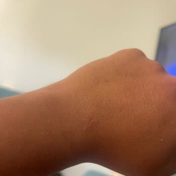 Garanti Kapsamındaki Saatte Renk Değişimi Ve Alerji Sorunu, Çözüm Sunulmuyor