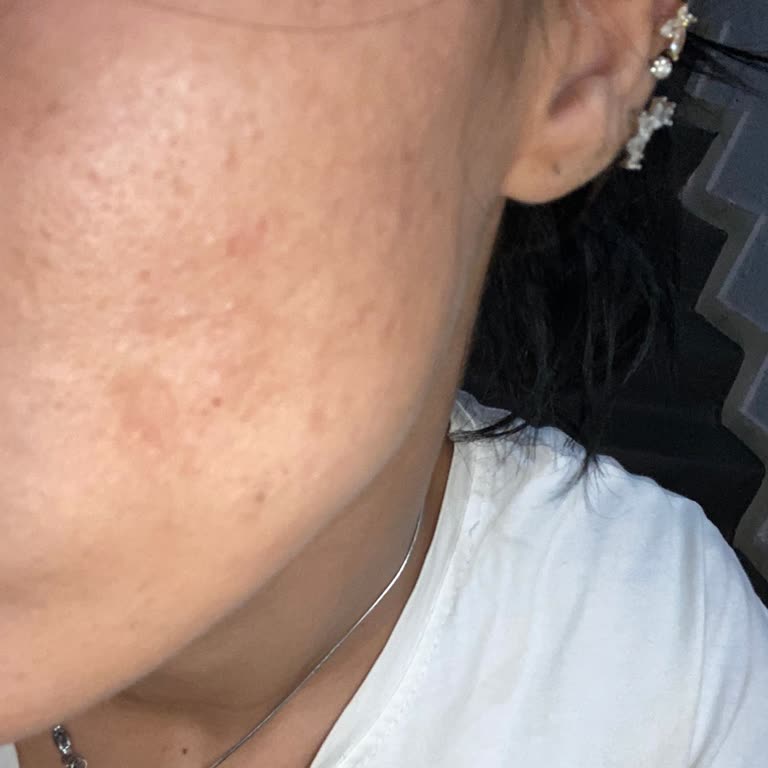 Cilt Bakımı Sonrası Siyah Noktalar Temizlenmedi Ücret İadesi İstiyorum