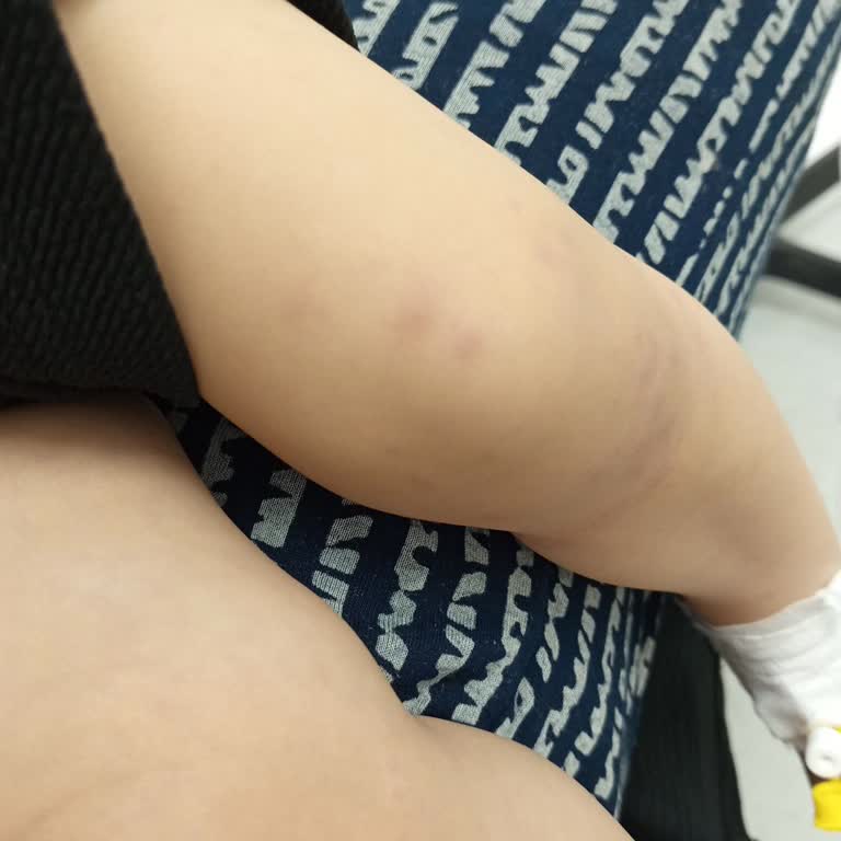 Çocuğumda İlacın Yol Açtığı Alerjiyle Yaşadığımız Endişe