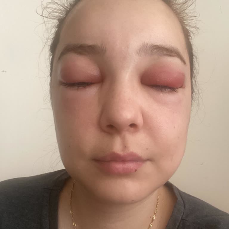 Botoks Sonrası Ciddi Alerjik Reaksiyon Ve Yetersiz Klinik Desteği