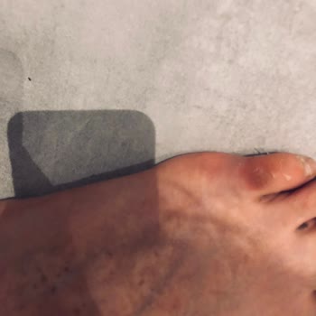 Yeni Alınan Nike Ayakkabı Kısa Sürede Ciddi Yara Ve Ağrıya Sebep Oldu